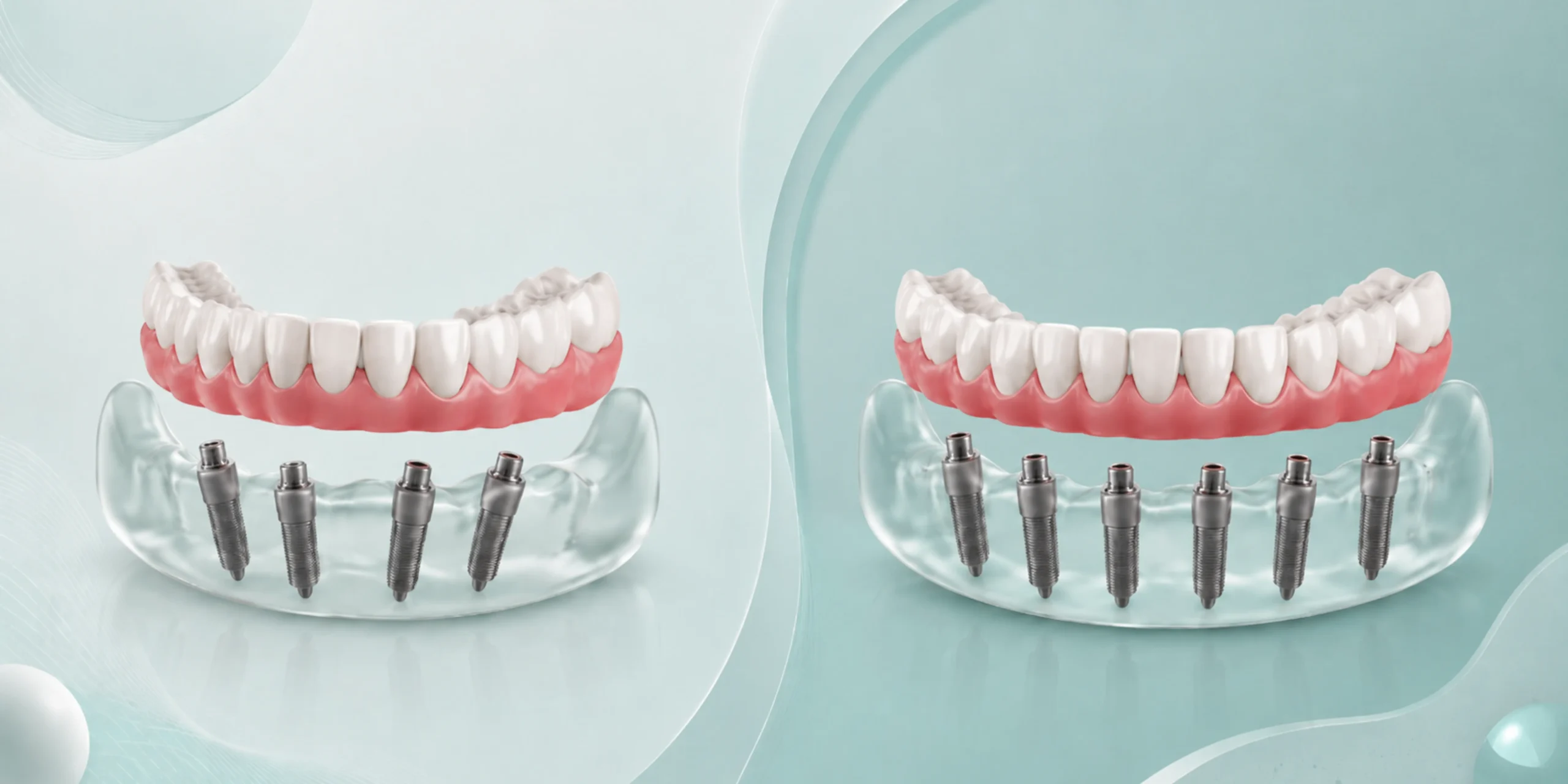 Dental Bridges in Albania: Types, Costs and When a Bridge Beats an Implant