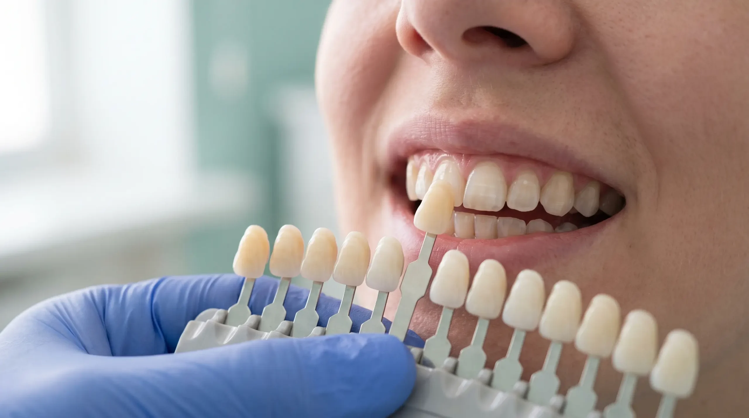 Teeth Whitening in Albania: Laser, In Office and Home Kits Compared