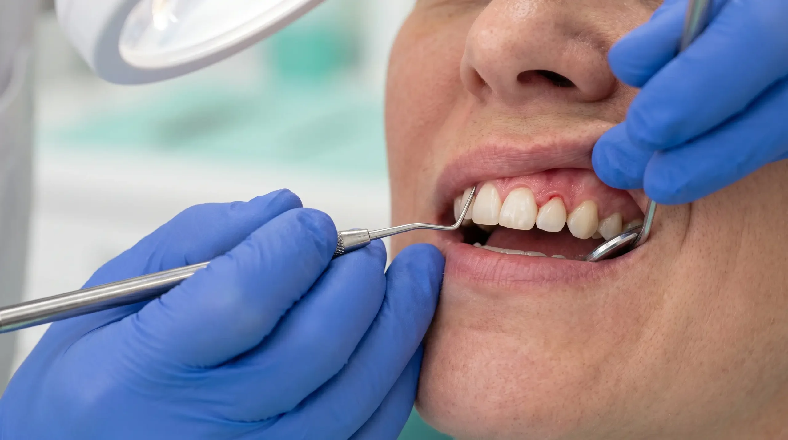 Gum Disease and Dental Implants: Why Gums Come First in Albania